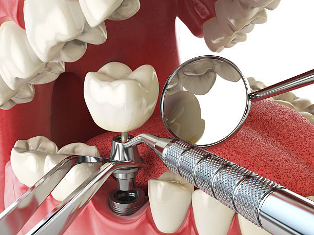 Best Emergency Treatment for Dental Infections or Abscesses in Warrenton, MO